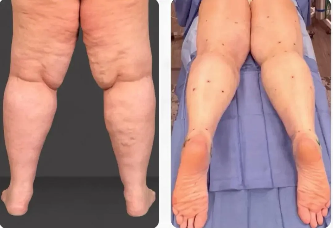 Lipœdème des jambes – avant / après liposuccion WAL, photo 3